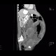 Metastasis of malignant melanoma in peritoneal cavity: CT - Computed tomography